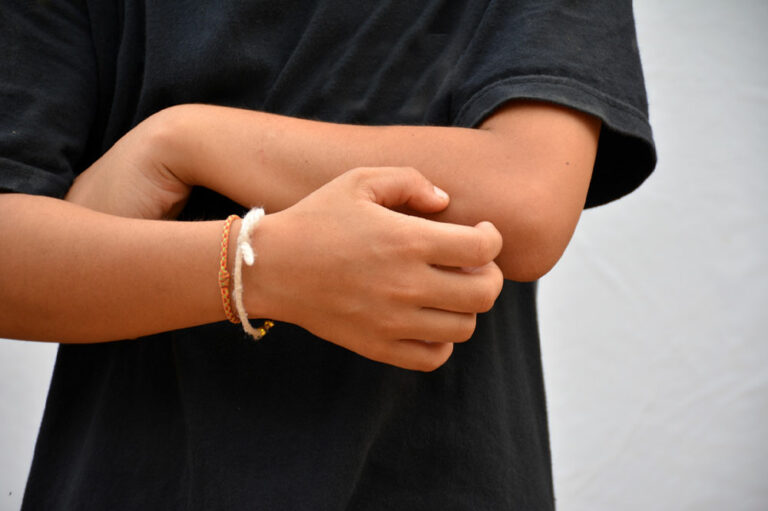 Prurigo nodularis – Causes, symptoms, and management